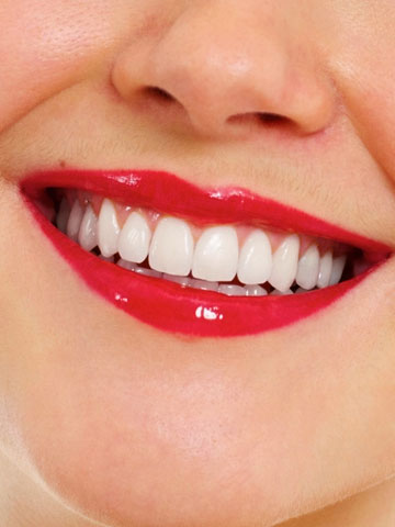 porcelain veneers